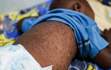 Measles and rubella cases rise across Africa as children bear the heaviest burden