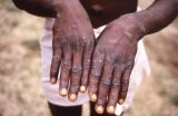 Ghana records 34 new Mpox cases, total now 79
