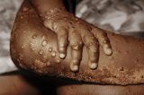 Ghana's Mpox cases soar to 302 as GHS confirms 20 new infections