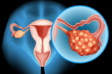 Joy Cancer Awareness Month: What you should know about Ovarian Cancer