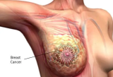 Joy Cancer Awareness Month: Aggressive breast cancers more common in Africans – Prof Akakpo