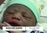 Bleached children may suffer brain damage, other health complications – Dr. Beyuo