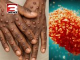 Ghana records first Mpox death as cases rise to 257