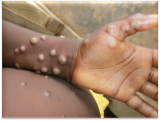 Ghana confirms 22 new Mpox cases, total infections hit 446