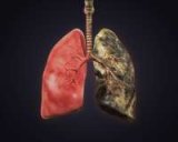 Lung Cancer in Rural Areas: Why Distance Shouldn’t Decide Outcomes?