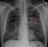 Joy Cancer Awareness Month: Late diagnosis fuelling high lung cancer deaths in Ghana — (…)