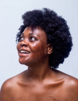 Burned at age 10, stigmatised but unafraid of never getting a husband – A burn survivor’s story