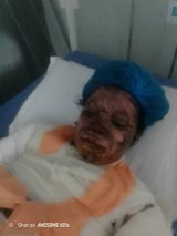 Mother and children suffer severe burns, appeal for support for life-saving treatment