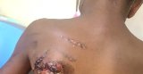 Mother faces Ho court for allegedly burning son over lost pen