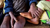 Ghana records its first monkey pox death, 23 confirmed active cases