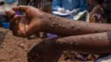Ghana’s Mpox cases rise to 409