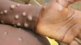 Mpox crisis: 71% of cases concentrated in Western Region