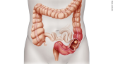 Joy Cancer Awareness Month: Colorectal cancer is common but preventable – Expert warns