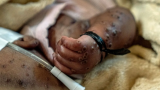 Ghana confirms 21 new Mpox cases