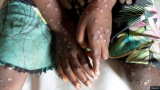 Ghana records 13 new Mpox cases, total now 670 — Ghana Health Service