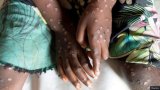 37 new Mpox cases recorded; total hits 409