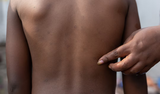 Mpox update: Ghana records 13 new cases, total now 993