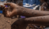 Six new Mpox cases confirmed in Ghana, total rises to 91